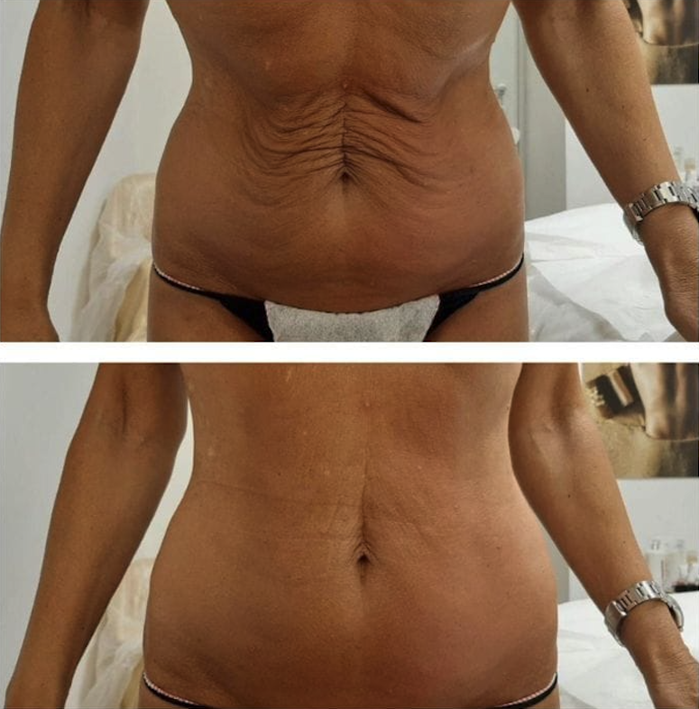 T2 3 treatments Abdomen