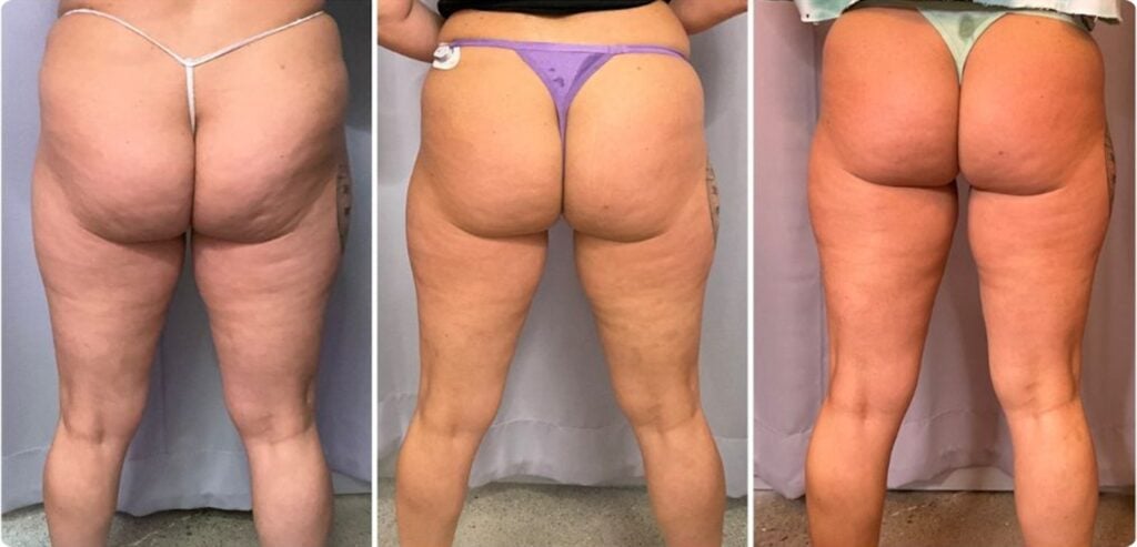 after 3 treatments