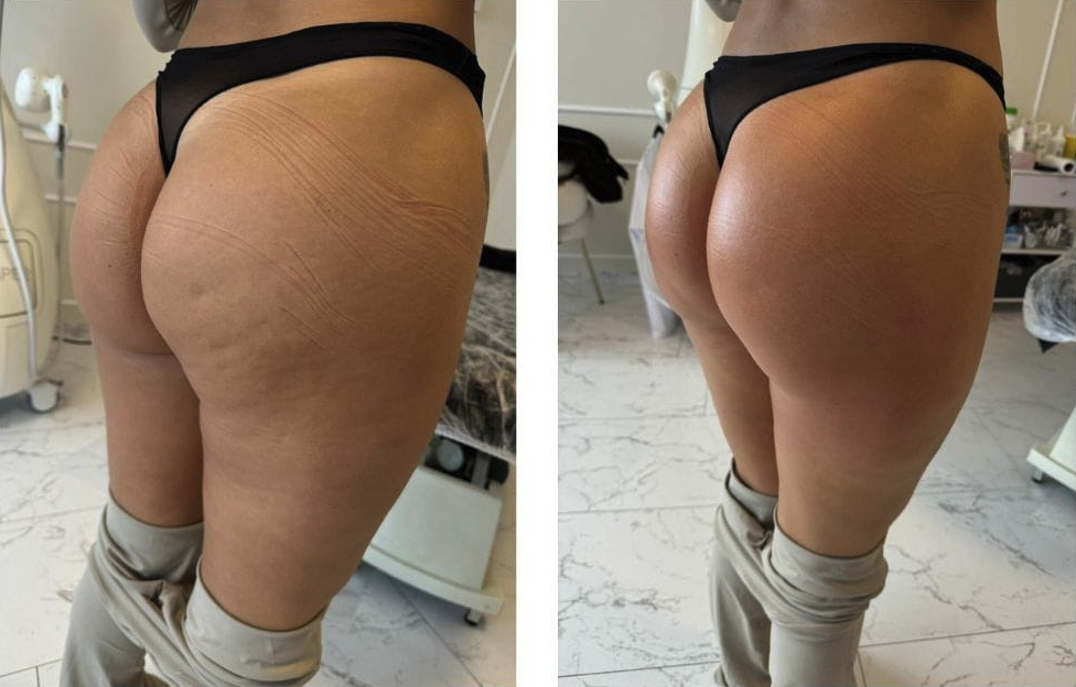 t shape 2 before after 1 treatments