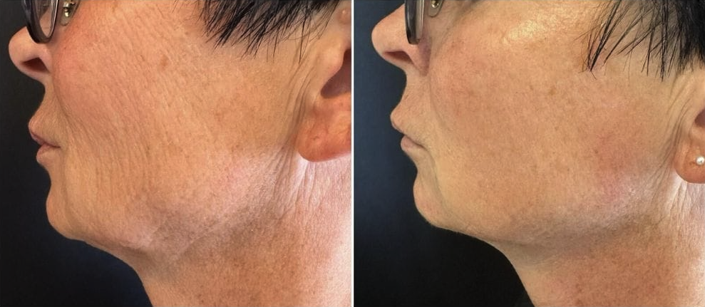 t shape 2 before after 3 treatments